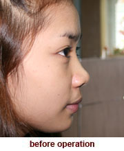 plastic_surgery_augmentation_rhinoplasty